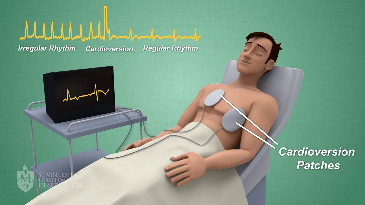 Cardioversão